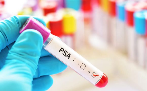 Antigenul prostatic specific PSA