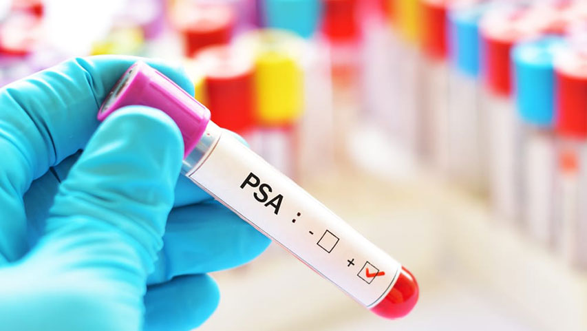 Antigenul prostatic specific PSA