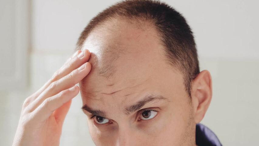 Căderea părului sau alopecia – cauze și tratament